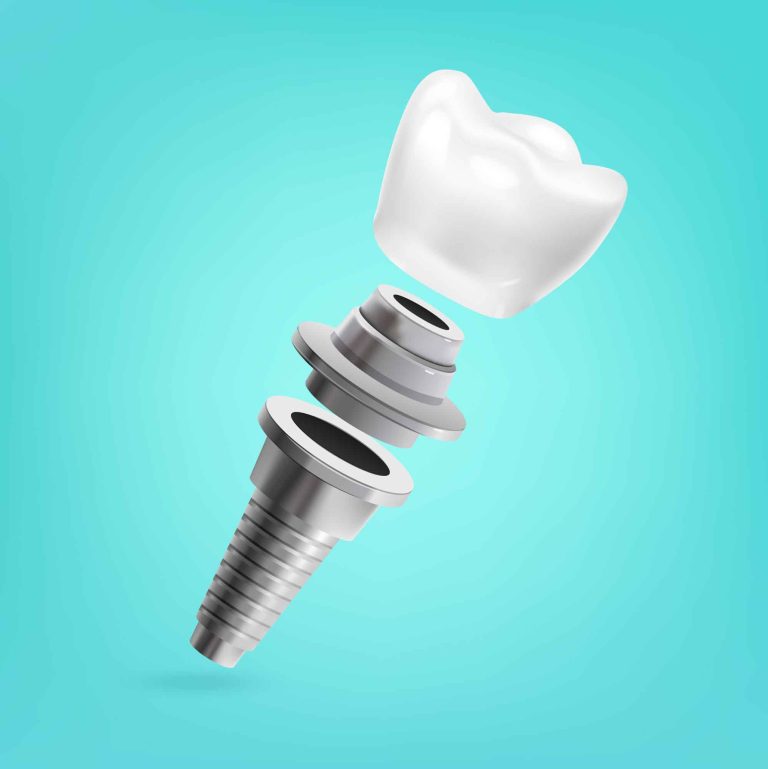 What is a dental implant and when do you need it?